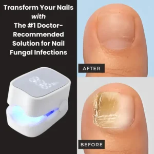 Nail fungus cleaning laser device - Image 5