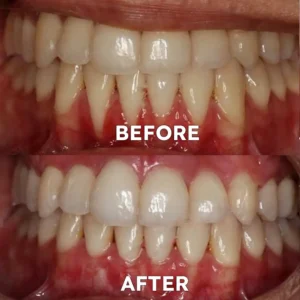 Fluoride-Free Nano Hydroxyapatite Tooth Powder - Image 5