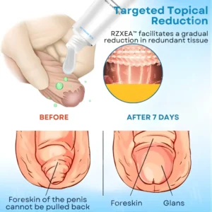 7-Day Redundant Prepuce Corrective Gel - Image 4