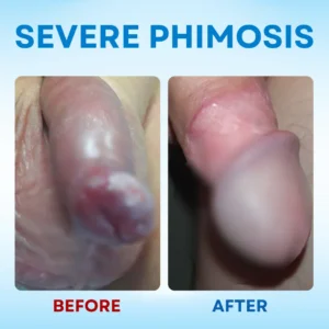 7-Day Redundant Prepuce Corrective Gel - Image 6