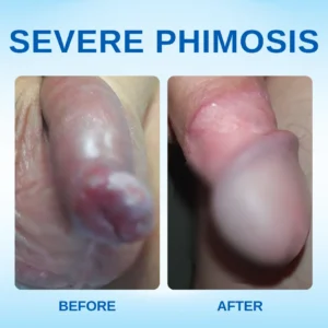 Redundant Prepuce Corrector Gel - Image 7