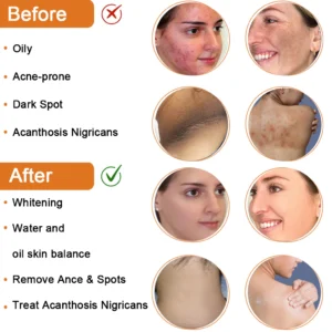 Cleansing Lotion for Acne & Spots & Acanthosis Nigricans Congratulations - Image 3