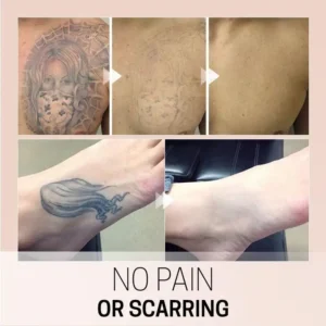 TatEraser Tattoo Removal Cream - Image 5