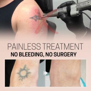 TatEraser Tattoo Removal Cream - Image 6