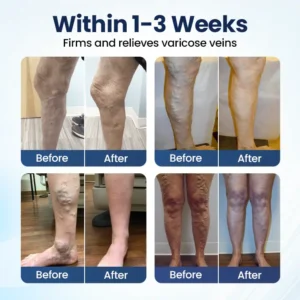 Deep Vein Repair Microneedle Patch - Image 2
