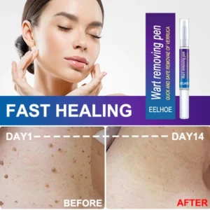 Wart removing pen - Image 2