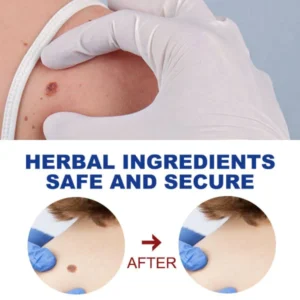 Wart removing pen - Image 3