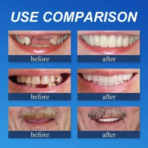 Medical Full Denture with Strong Suctiond Custom-Fit Full Functional Dentures - Image 3