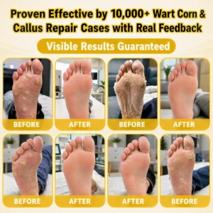 BEE POISON Corn & Callus Remover Cream - LOVILDS - Image 3