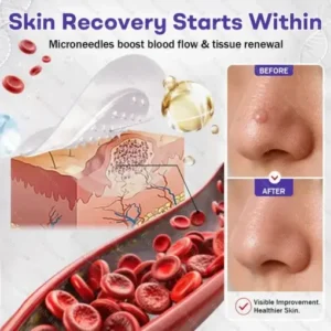 Wart and mole removal microneedle patch - Image 4