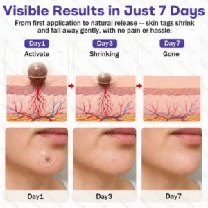 Wart and mole removal microneedle patch - Image 5
