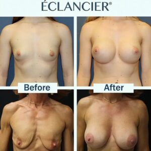 Targeted Breast Enhancement Advanced Nano Microneedle Patch - Image 4