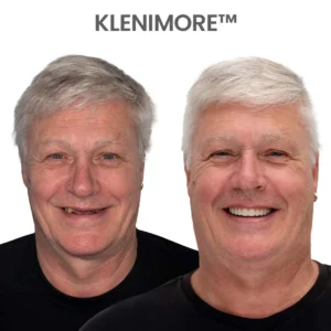 ⏰ Custom-Fit Dentures ENDS TODAY 70% OFF | Smile with Confidence - Image 17