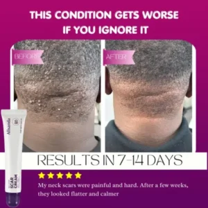 Keloid & Raised Scar Removal Cream - Image 3