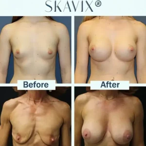 Skavix Targeted Breast Enhancement Advanced Nano-Microneedle Patches - Image 5