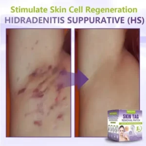 Soluble Microneedle Botanical Skin Tag Removal Patch - Image 10