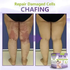 Soluble Microneedle Botanical Skin Tag Removal Patch - Image 7