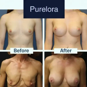 Targeted Breast Enhancement Advanced Nano Microneedle Patch - Image 3