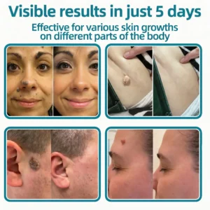 2-in-1 Microneedle & Hydrocolloid Patch - Image 3
