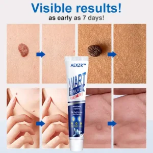 Wart Removal Ointment - Image 5