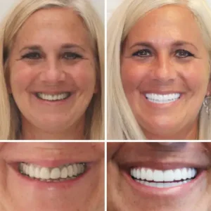 Advanced Customized Full Denture Set - Image 5