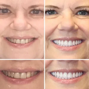 Advanced Customized Full Denture Set - Image 6