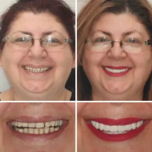 Advanced Customized Full Denture Set - Image 7