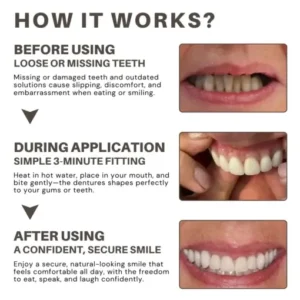 Custom-Fit Full Denture Set - Image 4