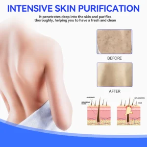 Keratosis Pilaris & Akne Behandlung Körper Erfrischende Creme - Image 3
