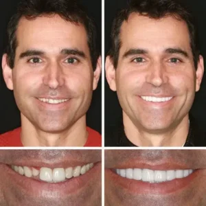 Premium Denture 2026 | Custom-Fit Dentures - Image 8