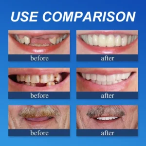 Custom Comfort Dentures - Image 5