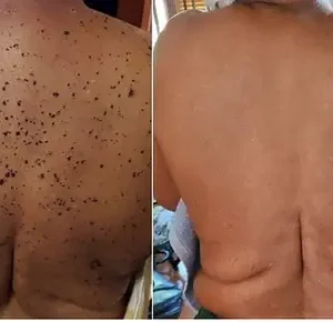 Bee Venom Mole and Wart Treatment Cream - Image 7