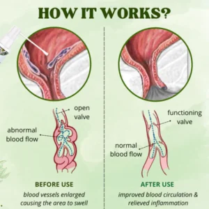 Natural Herbal Hemorrhoids Spray - Image 3