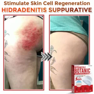 MicroNeedle Botanic Skin Tag Removal Patch - Image 10