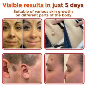 MicroNeedle Botanic Skin Tag Removal Patch - Image 4