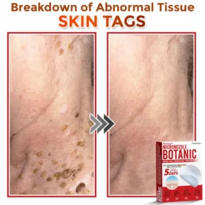 MicroNeedle Botanic Skin Tag Removal Patch - Image 6
