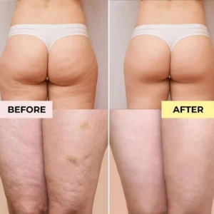 Slimoly Anti Cellulite Massage Oil - Skin Tightening Moisturizing - Image 10