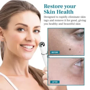 LumeSkin Mole and Wart Removal Laser Pen - Image 3