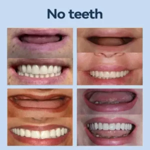 – MedicalFit Adaptive Dentures – Suitable for all mouth shapes perfect fit - Image 9