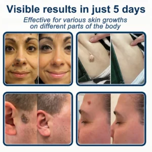 2-in-1 Microneedle & Hydrocolloid Patch - Image 3