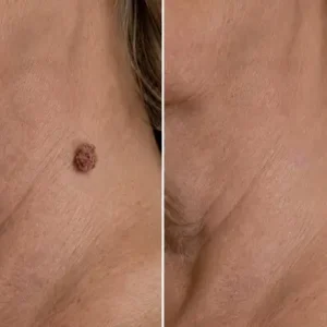 2-in-1 Microneedle & Hydrocolloid Patch - Image 6