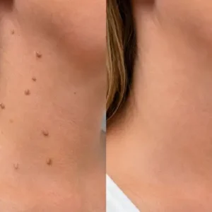 2-in-1 Microneedle & Hydrocolloid Patch - Image 7