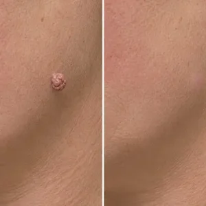 2-in-1 Microneedle & Hydrocolloid Patch - Image 9