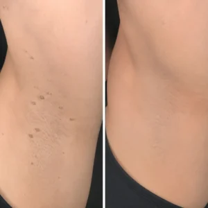 2-in-1 Microneedle & Hydrocolloid Patch - Image 13
