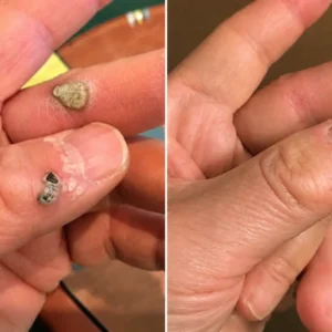 2-in-1 Microneedle & Hydrocolloid Patch - Image 7