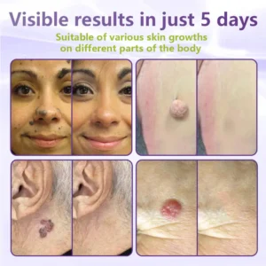 SOLUBLE MICRONEEDLE BOTANICAL SKIN TAG REMOVAL PATCH - Image 5
