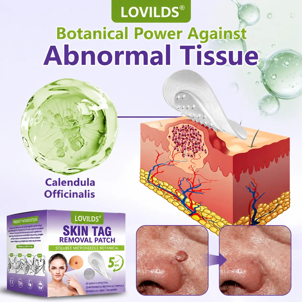 SOLUBLE MICRONEEDLE BOTANICAL SKIN TAG REMOVAL PATCH - Image 6