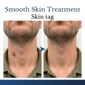 DermFixPro 2-in-1 Microneedle & Hydrocolloid Patch - Image 6