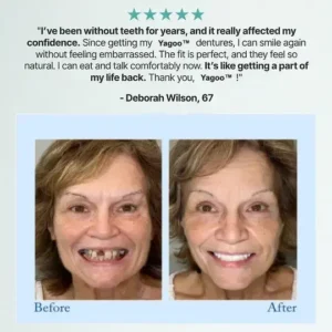 Advanced Customized Full Denture Set - Image 13