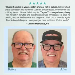 Advanced Customized Full Denture Set - Image 14